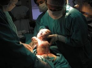 Keisarileikkaus: 3 asiaa jotka sinun tulisi tietää