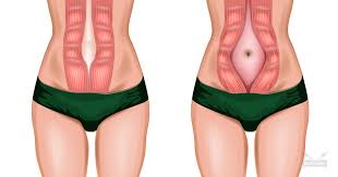 vatsalihasten erkauma