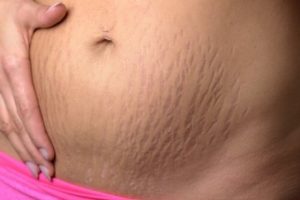 Raskausarvet: mitä ne ovat ja miten niitä voi hoitaa?