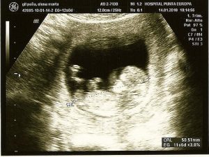 Innovatiivisia tapoja havaita raskaudenaikaisia komplikaatioita