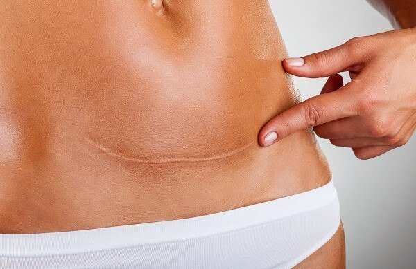 Keisarileikkauksen evolutiiviset vaikutukset naisen kehoon