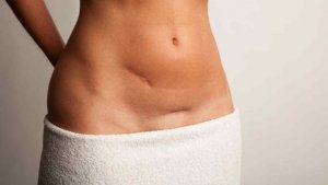 Keisarileikkaus ei ole helppo tapa synnyttää