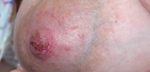 Kipeiden ja halkeilevien nännien ehkäisy ja hoito