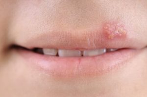 Lasten herpes: Oireet, syyt ja hoito