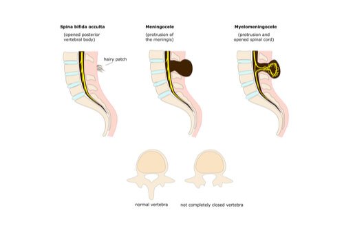 Spina bifida eli selkärankahalkio