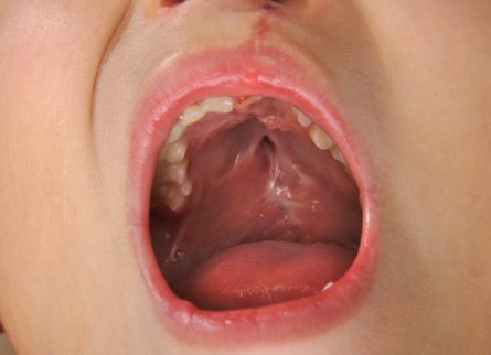 Lapsen suulakihalkio - kaikki, mitä tarvitsee tietää