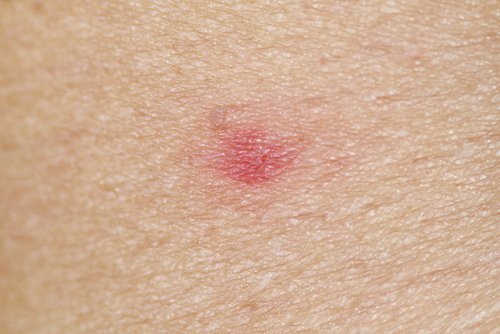 Ampiaisen pisto lapsella