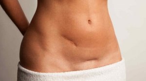 Arpien häivyttäminen ja hoito muutaman yksinkertaisen vinkin avulla