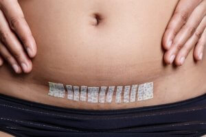 Mitä kohdunpoisto tarkoittaa ja miten se vaikuttaa äidiksi tuloon?