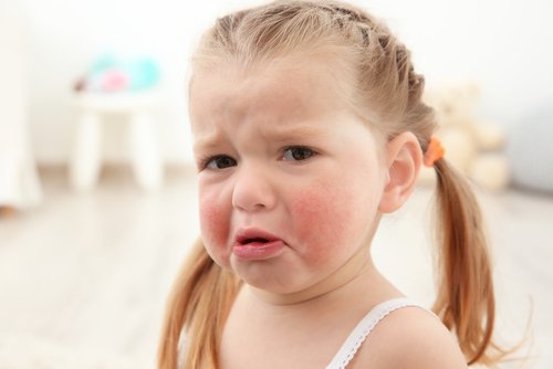Lasten ruoka-aineallergiat voivat aiheuttaa muun muassa allergista ihottumaa