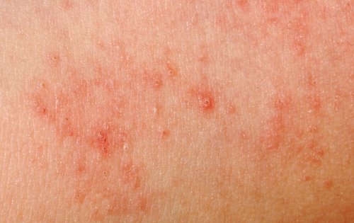 Ihoallergian syntymistä voi ehkäistä esimerkiksi kosteuttamalla ihoa