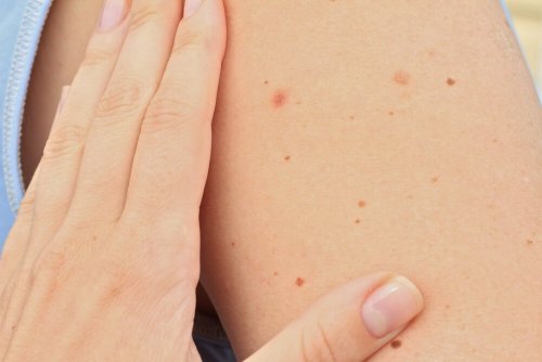 Lapsen luomet ja epänormaalien ihomuutosten tunnistaminen