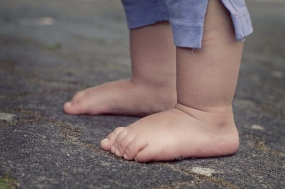 Lapsen akondroplasia