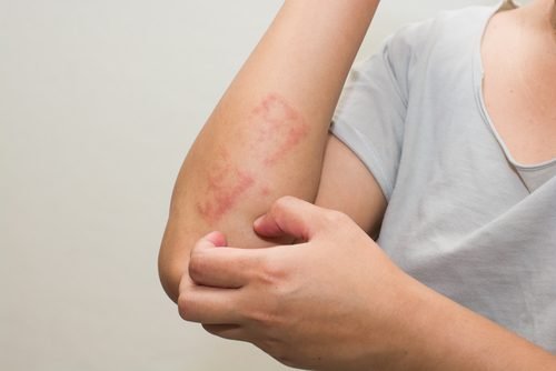 Lapsen psoriaasi ja oireiden helpottaminen luonnollisin keinoin