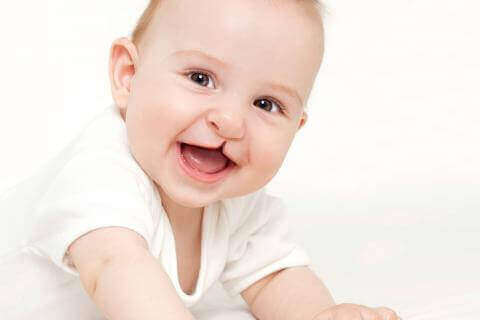 Yleisimmät lasten pään ja kasvojen alueen epämuodostumat