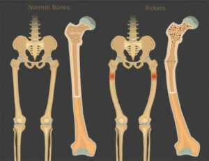D-vitamiinin puutteen aiheuttama riisitauti