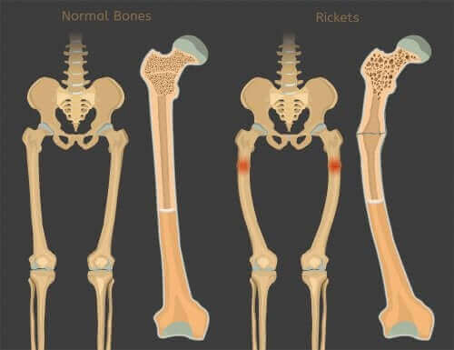 D-vitamiinin puutteen aiheuttama riisitauti