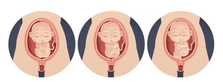 Mikä on perätilasynnytys?