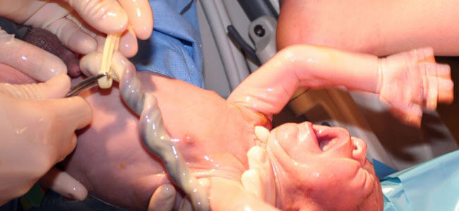 Napanuoran esiinluiskahdus voi tapahtua loppuraskaudessa tai synnytyksen aikana