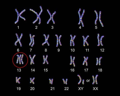 Pataun oireyhtymä eli trisomia 13