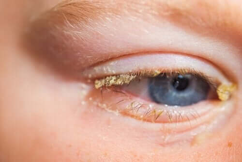 Vauvan sidekalvotulehdus