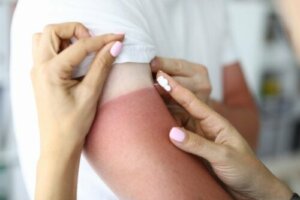 10 luonnollista lääkettä auringonpolttamiin