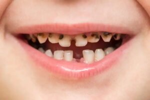 Jos lapsen hammas on muuttunut harmaaksi, lapsi tulee viedä hammaslääkäriin.