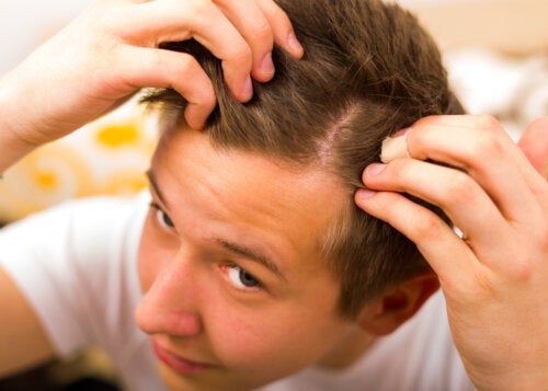 Kuinka ehkäistä nuoruusiän alopeciaa?