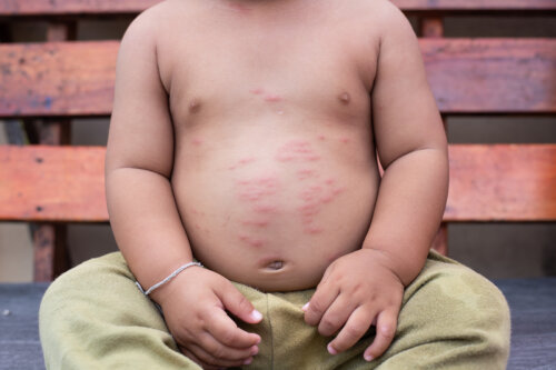Ihoallergioista kärsivät lapset: oireet ja suositukset