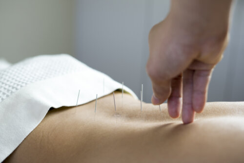 Auttaako akupunktio raskaaksi tulemisessa?