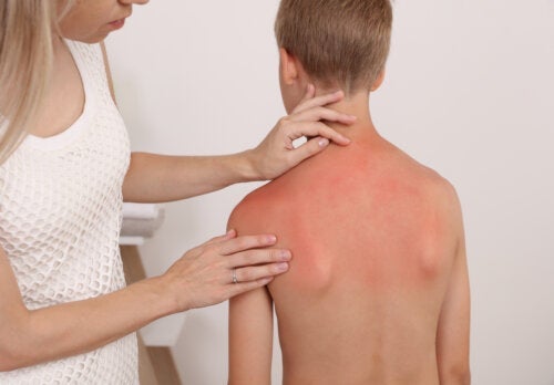 Lapsen ihon palaminen auringossa: mitä tulee tietää