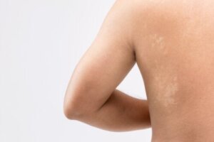 Pityriasis versicolor vauvoilla ja lapsilla